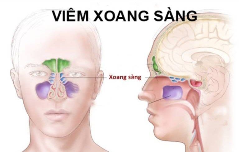 Tất tần tật về viêm xoang sàng – Những điều bạn cần biết!
