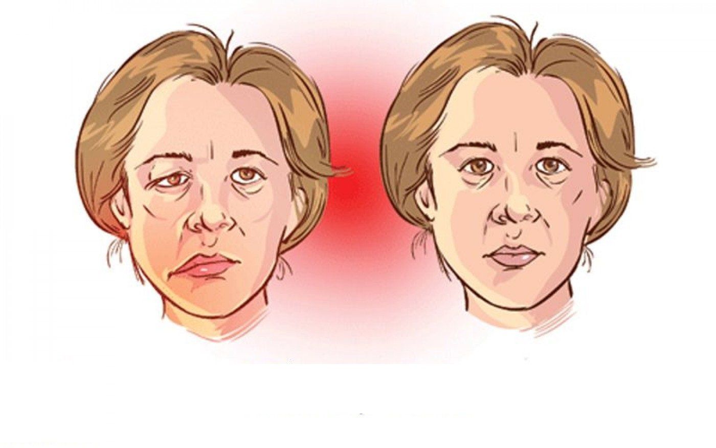 Cơ chế hình thành bệnh nhược cơ (myasthenia gravis) | Vinmec