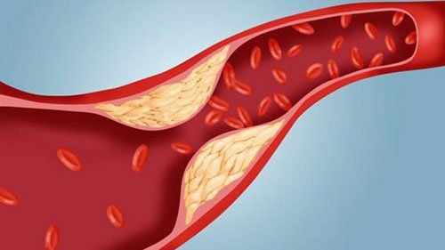 Xơ vữa động mạch có thể gây ra bệnh hẹp van động mạch chủ