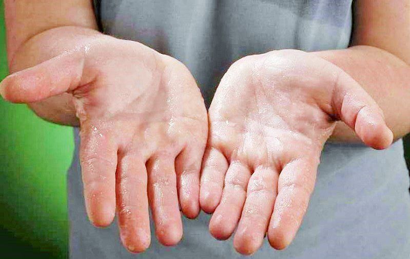Excessive sweating uncontrollably, how to treat?