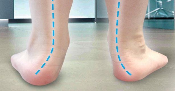 Trẻ 4 tuổi bị bàn chân bẹt nên làm gì? | Vinmec