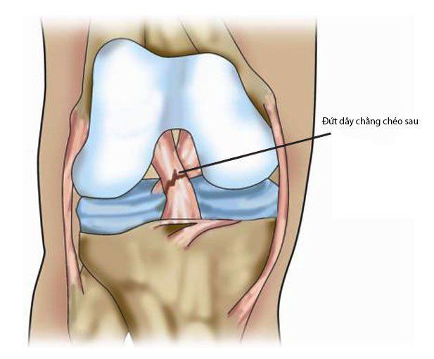 Chấn thương dây chằng chéo sau: Nguyên nhân, triệu chứng và chẩn đoán |  Vinmec