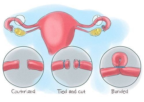 Tubal ligation is known as a safe and permanent method of contraception with minimal side effects on the body.