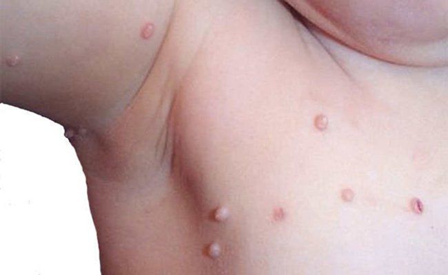 Sùi mào gà ở trẻ em lây qua đường nào? | Vinmec