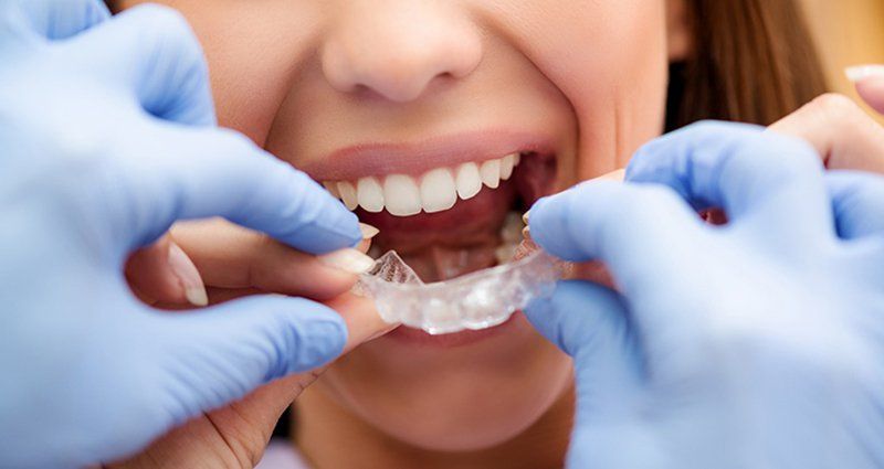 Vai trò của máng chống nghiến răng | Vinmec