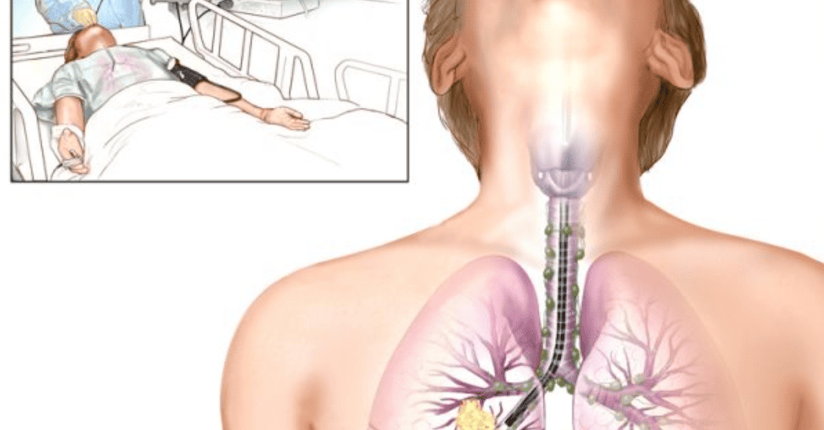 Nội soi phế quản giúp quan sát trực tiếp và lấy mẫu bệnh phẩm chính xác
