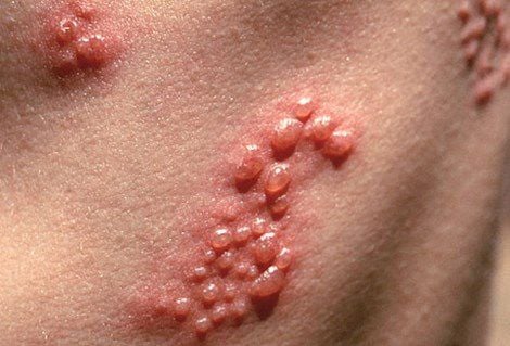The initial symptom of shingles is the appearance of blisters.
