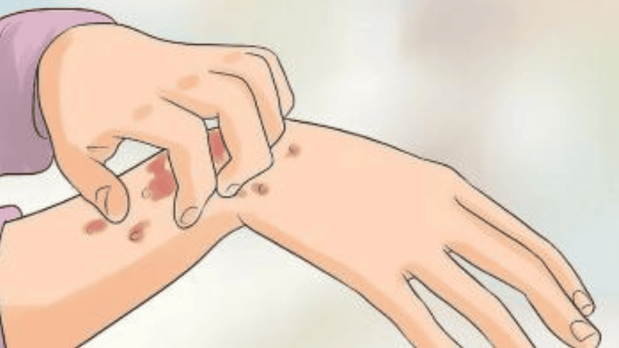 Syphilis: A visual guide through the stages | Vinmec