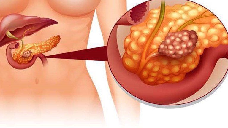 Dịch tụy có chức năng gì? | Vinmec