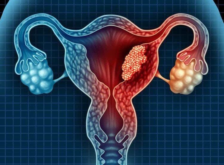 Ung thư buồng trứng: PET/CT, MRI và các biện pháp khác để chẩn đoán | Vinmec