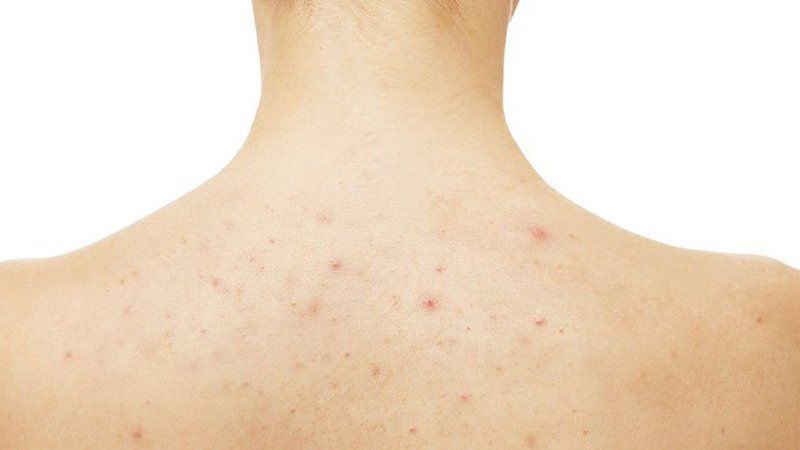 Folliculitis recurrence, what to do? | Vinmec