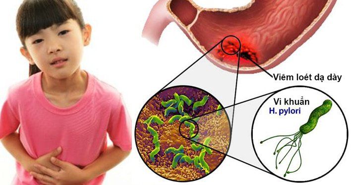 TRIỆU CHỨNG NHIỄM VI KHUẨN HP Ở TRẺ EM THƯỜNG GẶP NHẤT LÀ ĐAU BỤNG KÉO DÀI