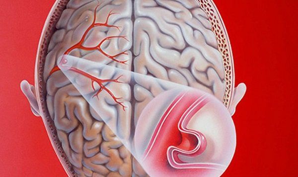 Vỡ túi phình mạch máu não: Biến chứng nguy hiểm | Vinmec
