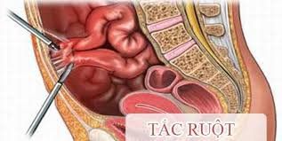 Tắc ruột là biến chứng có thể gặp sau khi phẫu thuật