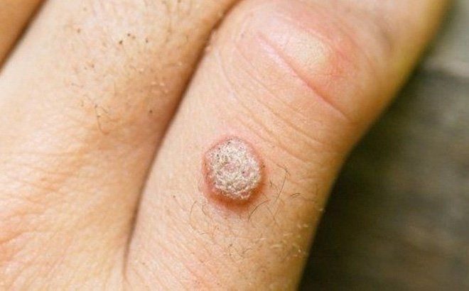 Cắt mụn cóc có nên uống thuốc kháng sinh? | Vinmec