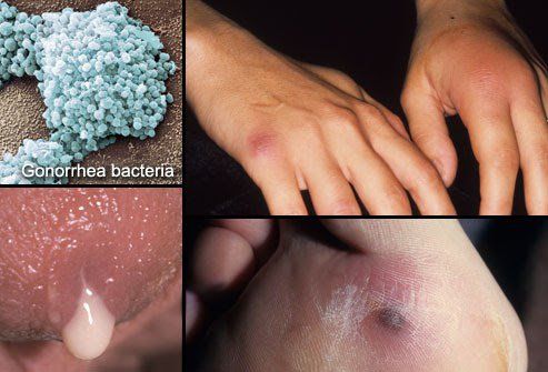 Gonorrhea is caused by Neisseria gonorrhoeae