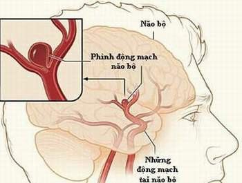Phình động mạch não