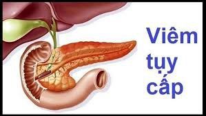 Viêm tụy cấp là biến chứng của sỏi mật