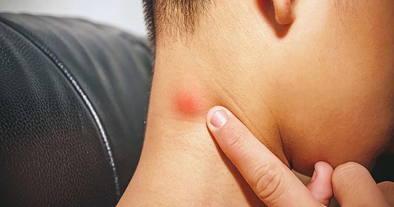 Trẻ 3 th&aacute;ng nổi hạch ở n&aacute;ch v&agrave; cổ sau ti&ecirc;m ph&ograve;ng lao phải ...