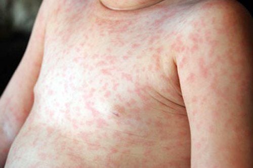 
Sởi là một bệnh nguy hiểm và có khả năng lây truyền cao
