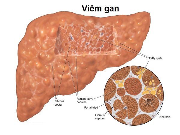 Người mắc bệnh gan nhiễm mỡ cần kiêng những gì?