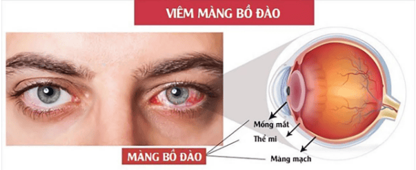 Bệnh viêm màng bồ đào: Phân loại và triệu chứng thường gặp | Vinmec