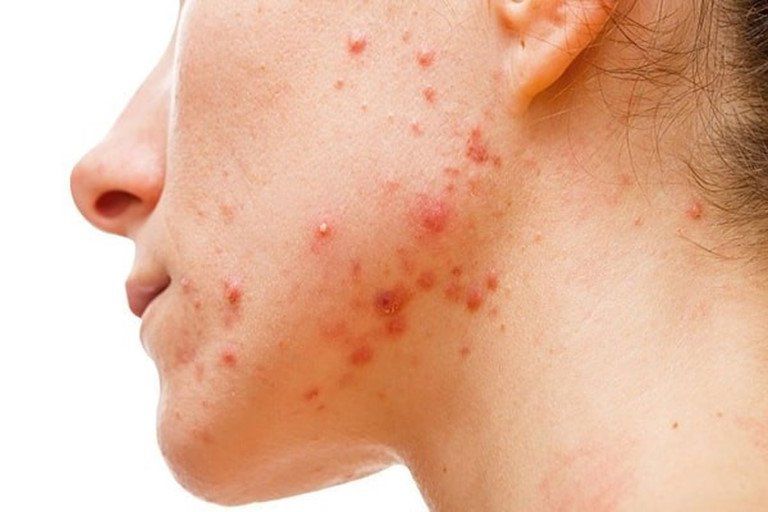 Trị Mụn Hiệu Quả Không Thuốc Với ACNE STUDIO by PMT