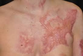 Bệnh nhân bỏng cần một chế độ dinh dưỡng nhằm tái tạo mô, nâng cao thể trạng