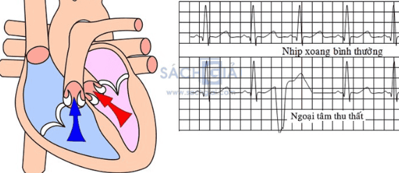 BỆNH NGOẠI TÂM THU THẤT LÀ RỐI LOẠN NHỊP TIM PHỔ BIẾN GÂY TIM ĐẬP KHÔNG ĐỀU