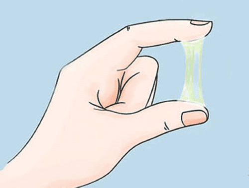 What should I do if I have excessive vaginal discharge, discomfort from moisture, irregular menstrual cycles, and polycystic ovary syndrome?