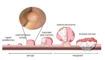 Polyp lesions when still localized in the mucosal layer (benign lesions on the left), and when cancer has invaded the muscle layer and serosa layer (malignant lesions on the right)