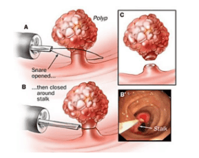 Colon polyp removal technique through endoscopy