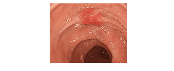 A polyp in the descending colon might show mucosal folds converging toward it, with pathological results confirming submucosal invasive cancer.