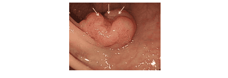 Polyps with Surface Ulcers: It is important to be wary of the risk of invasive cancer in this type of polyp.