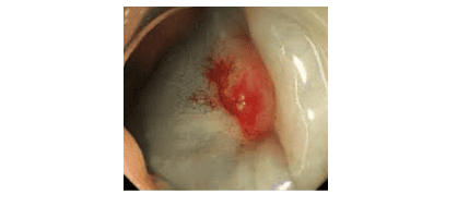 A polyp that does not lift after submucosal injection (referred to as the Non-Lifting Sign) cannot be removed endoscopically.