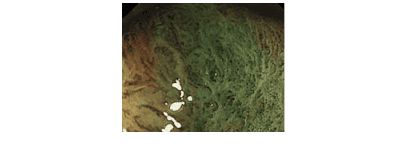 The absence of micro-surface structures and micro-vessels on the polyp surface may suggest the presence of cancerous polyps that have invaded the submucosa.