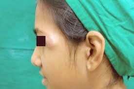U thượng bì vôi hoá xuất hiện tại vùng mặt của người bệnh