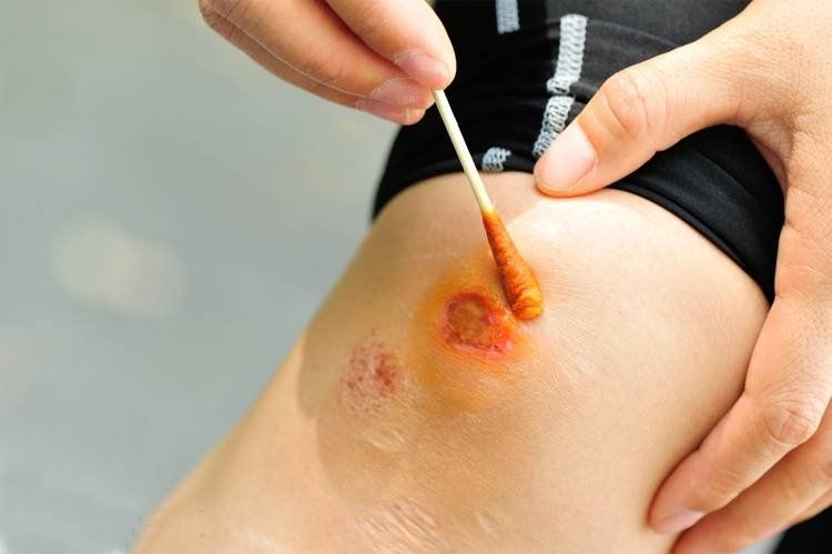 Thuốc Đỏ Rửa Vùng Kín