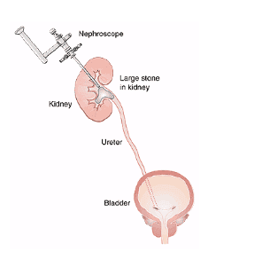Phương pháp lấy sỏi qua da có thể gây tổn thương các cơ quan lân cận