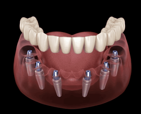 Cấy ghép Implant là kỹ thuật hiện đại trong lĩnh vực răng hàm mặt