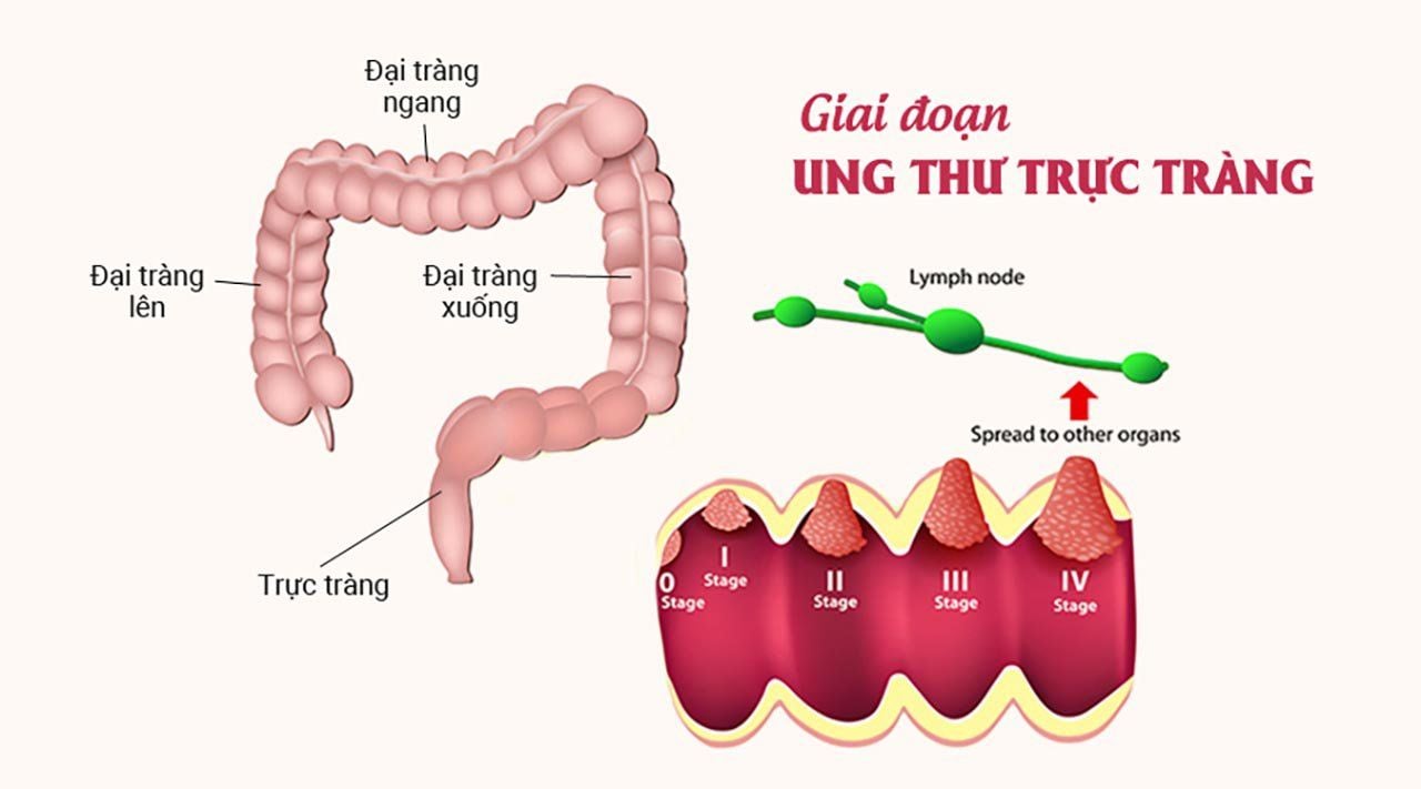 Ung thư trực tràng sống bao lâu? 