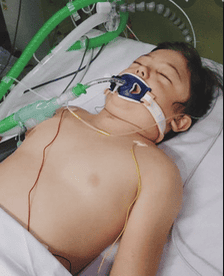 Bệnh nhân bị rách khí quản cần tiến hành mở khí quản cấp cứu