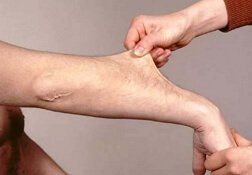 Hội chứng Ehlers-Danlos