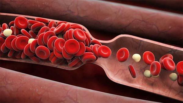 Triệu chứng và nguyên nhân của lưu thông máu kém | Vinmec