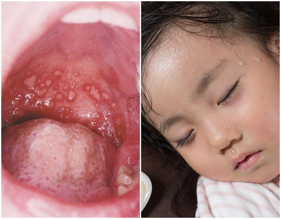 Herpangina là bệnh gì? | Vinmec