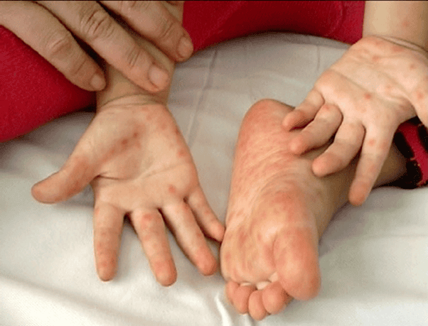 Bệnh tay chân miệng: Dấu hiệu phát hiện sớm và cách phòng tránh bệnh chân  tay miệng vào mùa hè | Vinmec