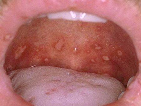 
Trẻ bị tay chân miệng cần được điều trị sớm để tránh biến chứng nguy hiểm
