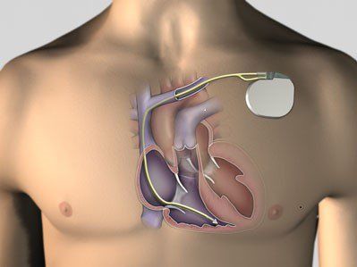 Severe RBBB cases may require the implantation of a permanent pacemaker.