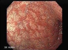 Endoscopic image of atrophic gastritis
