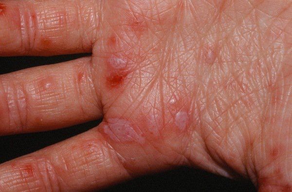 Đặc điểm bệnh tay chân miệng ở người lớn | Vinmec